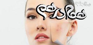 راهکارهای درمان جوش صورت